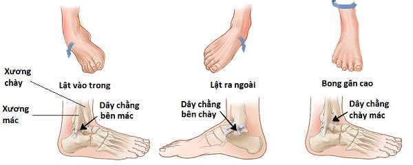 Những triệu chứng cho thấy bạn bị lật cổ chân